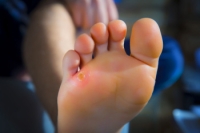 Corns and Calluses on the Feet Explained