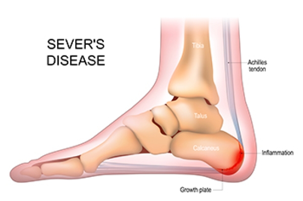 What Is Sever's Disease?