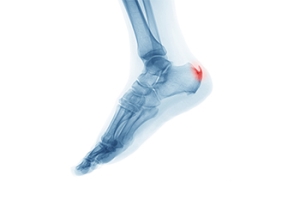 Heel Spurs and Their Causes