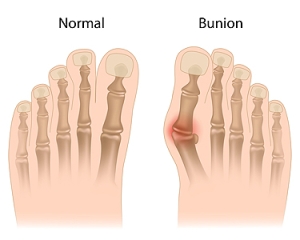 Bunions and Their Causes